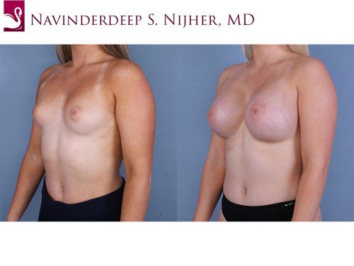 Breast Augmentation Case #64565 (Image 2)