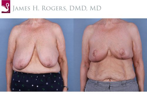 Female Breast Reduction Case #65229 (Image 1)