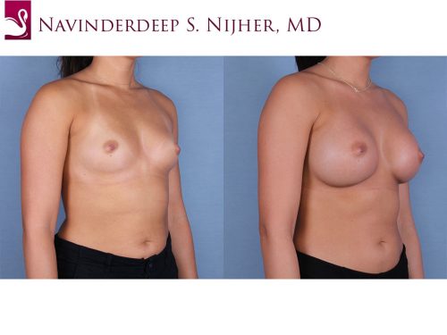 Breast Augmentation Case #65649 (Image 2)