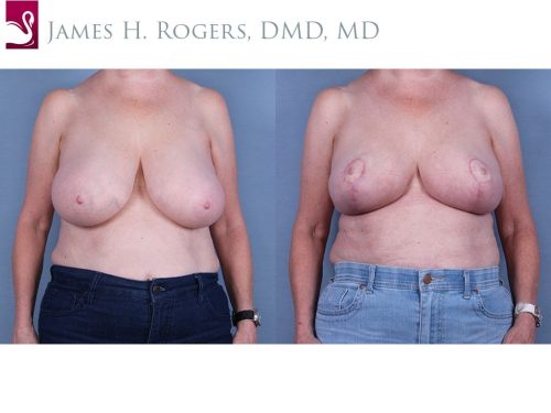 Female Breast Reduction Case #64102 (Image 1)