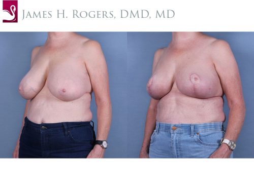 Female Breast Reduction Case #64102 (Image 2)