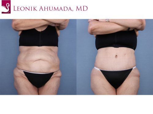 Abdominoplasty (Tummy Tuck) Case #65295 (Image 1)