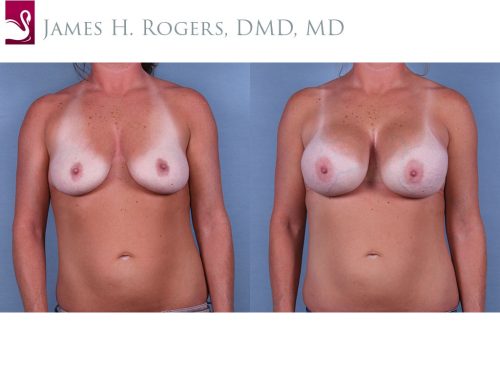 Breast Augmentation Case #64936 (Image 1)