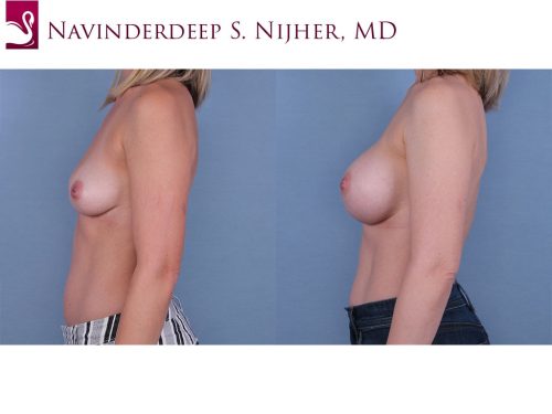 Breast Augmentation Case #65571 (Image 3)