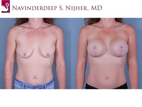 Breast Lift (Mastopexy) Case #66402 (Image 1)