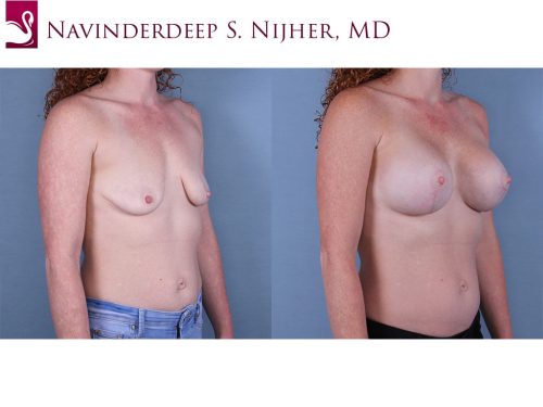 Breast Lift (Mastopexy) Case #66402 (Image 2)