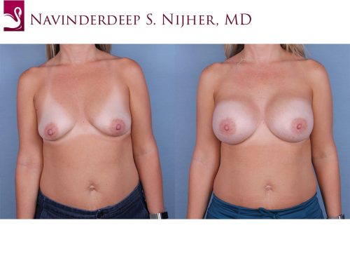 Breast Augmentation Case #64909 (Image 1)