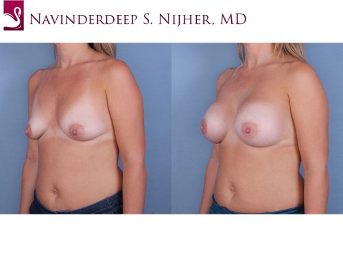 Breast Augmentation Case #64909 (Image 2)
