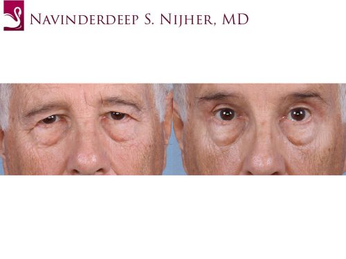Eyelid Surgery Case #65097 (Image 1)