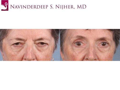 Eyelid Surgery Case #65395 (Image 1)