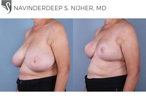 Female Breast Reduction Case #65908 (Image 2)