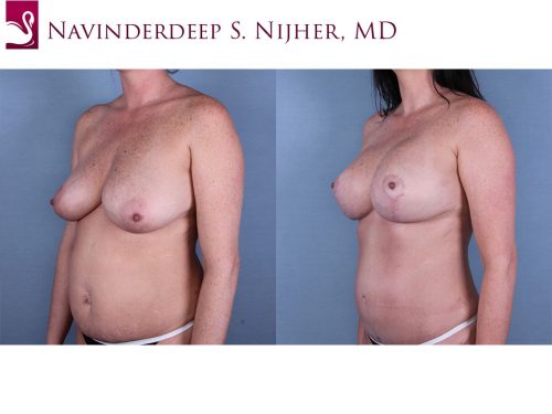 Breast Augmentation with Mastopexy (Breast Lift) Case #65911 (Image 2)