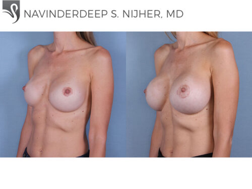 Breast Augmentation Case #66192 (Image 2)