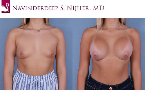 Breast Augmentation Case #66512 (Image 1)