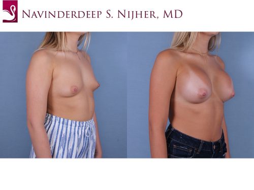 Breast Augmentation Case #66512 (Image 2)