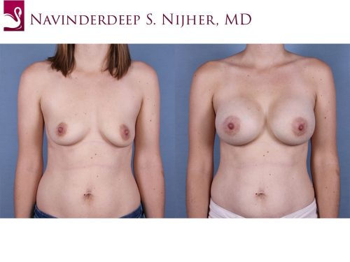 Breast Augmentation Case #66642 (Image 1)