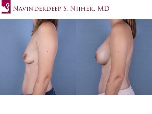 Breast Augmentation Case #66642 (Image 3)