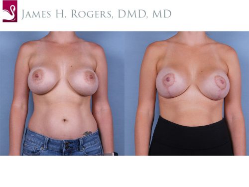 Breast Lift (Mastopexy) Case #53251 (Image 1)