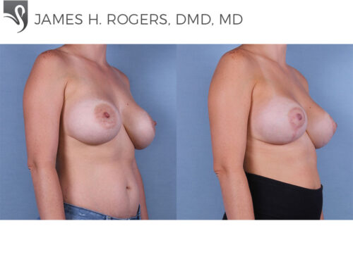 Breast Lift (Mastopexy) Case #53251 (Image 2)