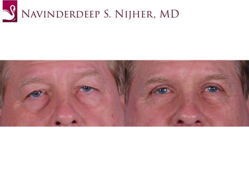 Eyelid Surgery Case #62816 (Image 1)