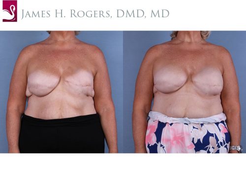 Breast Reconstruction Case #65479 (Image 1)