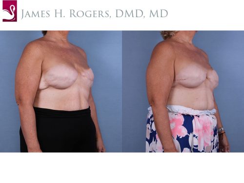 Breast Reconstruction Case #65479 (Image 2)