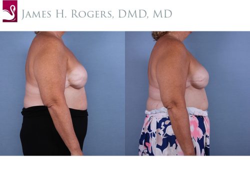 Breast Reconstruction Case #65479 (Image 3)