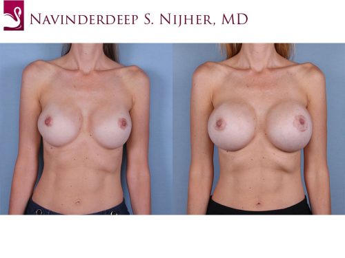 Breast Revisions Case #66192 (Image 1)