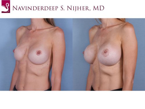 Breast Revisions Case #66192 (Image 2)