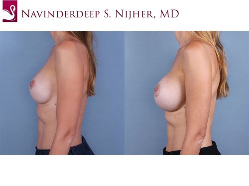 Breast Revisions Case #66192 (Image 3)