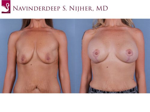 Breast Augmentation with Mastopexy (Breast Lift) Case #67015 (Image 1)