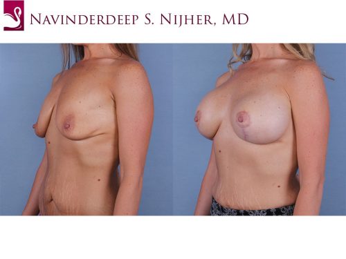 Breast Augmentation with Mastopexy (Breast Lift) Case #67015 (Image 2)