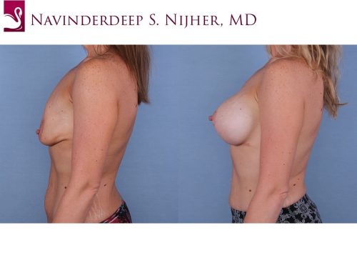 Breast Augmentation with Mastopexy (Breast Lift) Case #67015 (Image 3)