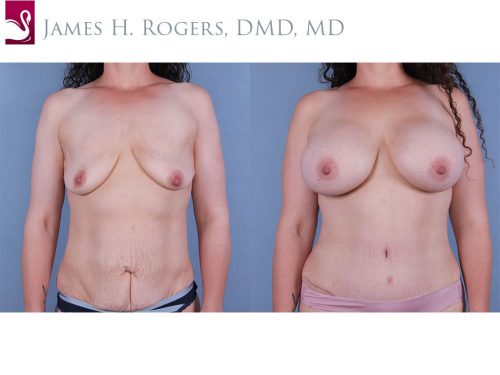 Breast Augmentation Case #67179 (Image 1)