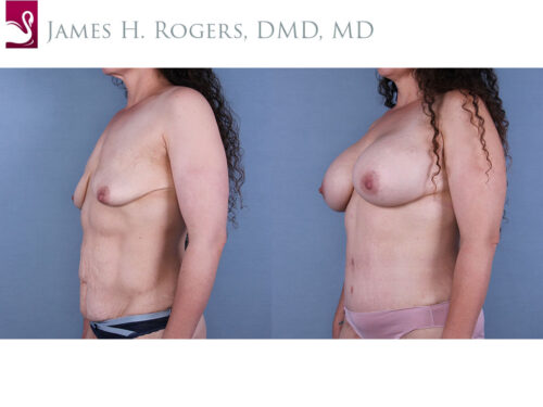 Breast Augmentation Case #67179 (Image 2)