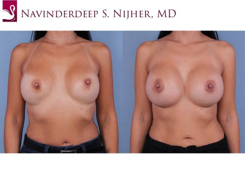 Breast Augmentation Case #38745 (Image 1)