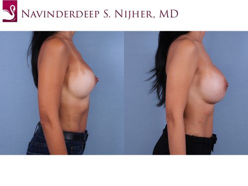 Breast Augmentation Case #38745 (Image 3)