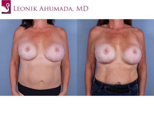 Breast Revisions Case #64758 (Image 1)