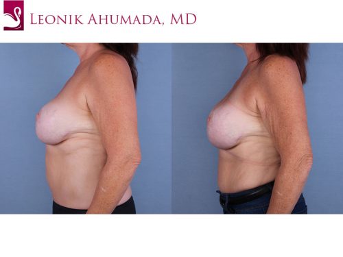 Breast Revisions Case #64758 (Image 3)