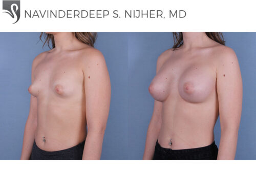 Breast Augmentation Case #66763 (Image 2)