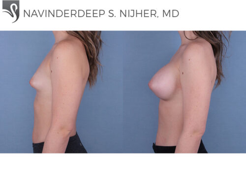 Breast Augmentation Case #66763 (Image 3)