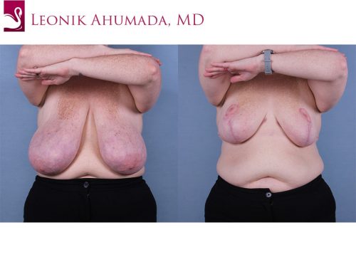 Before and after image of a real plastic surgery procedure performed by Dr. Ahumada.