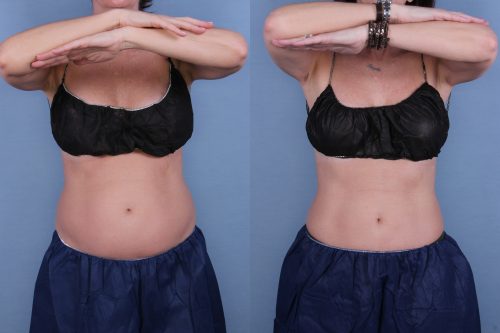 Before and after image of a real CoolSculpting treatment performed by Ocala Plastic Surgery.