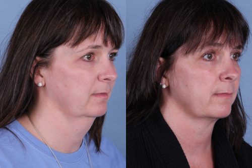 Before and after image of a real CoolSculpting treatment performed by Ocala Plastic Surgery.