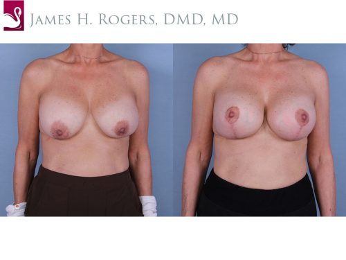Breast Augmentation with Mastopexy (Breast Lift) Case #67883 (Image 1)
