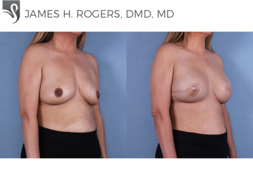 Breast Reconstruction Case #66246 (Image 2)