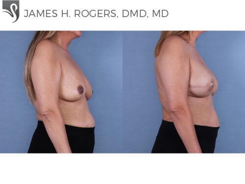 Breast Reconstruction Case #66246 (Image 3)