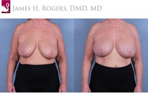 Breast Augmentation with Mastopexy (Breast Lift) Case #67790 (Image 1)