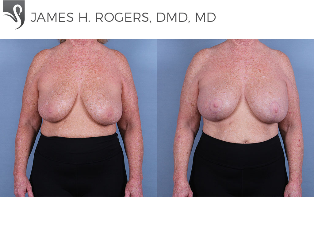 67790-Breast Lift - Ocala Plastic Surgery