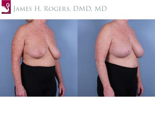 Breast lift – Mastopexy  DG Laser & Cosmetic Gynecology Clinic